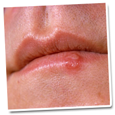 herpes - need treatment